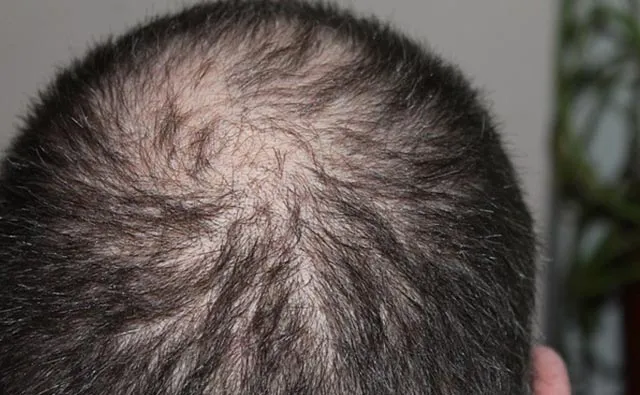 Hair Loss/Development Composition Has Phellandrene as Active Ingredient